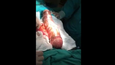 (Video) Médicos tuvieron que reconstruirle el recto a hombre que le extraen yuca de 45 cm
