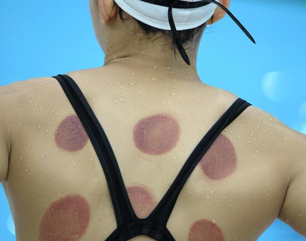 ¿Por qué los atletas de los Juegos Olímpicos tienen esas marcas rojas en la piel?