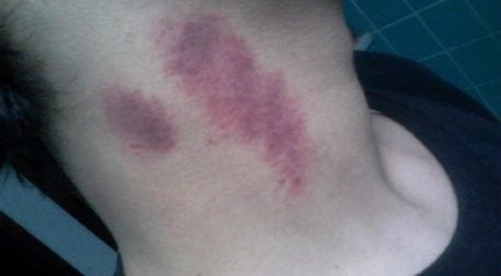 Los peligros de un chupón amoroso en el cuello