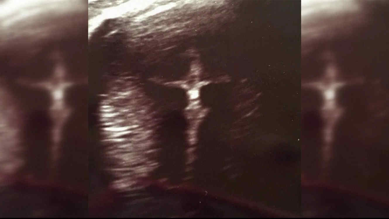 (Video) Increíble: Aparece imagen de Cristo crucificado en ultrasonido de bebé enfermo