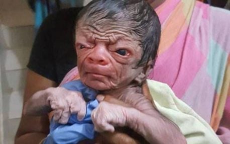 (FOTO + VIDEO) Nace otro bebé que recuerda el caso de «Benjamín Button»