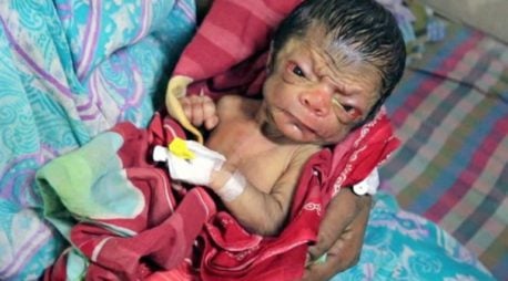 Benjamin Button es real: nace bebé anciano conmueve las redes sociales