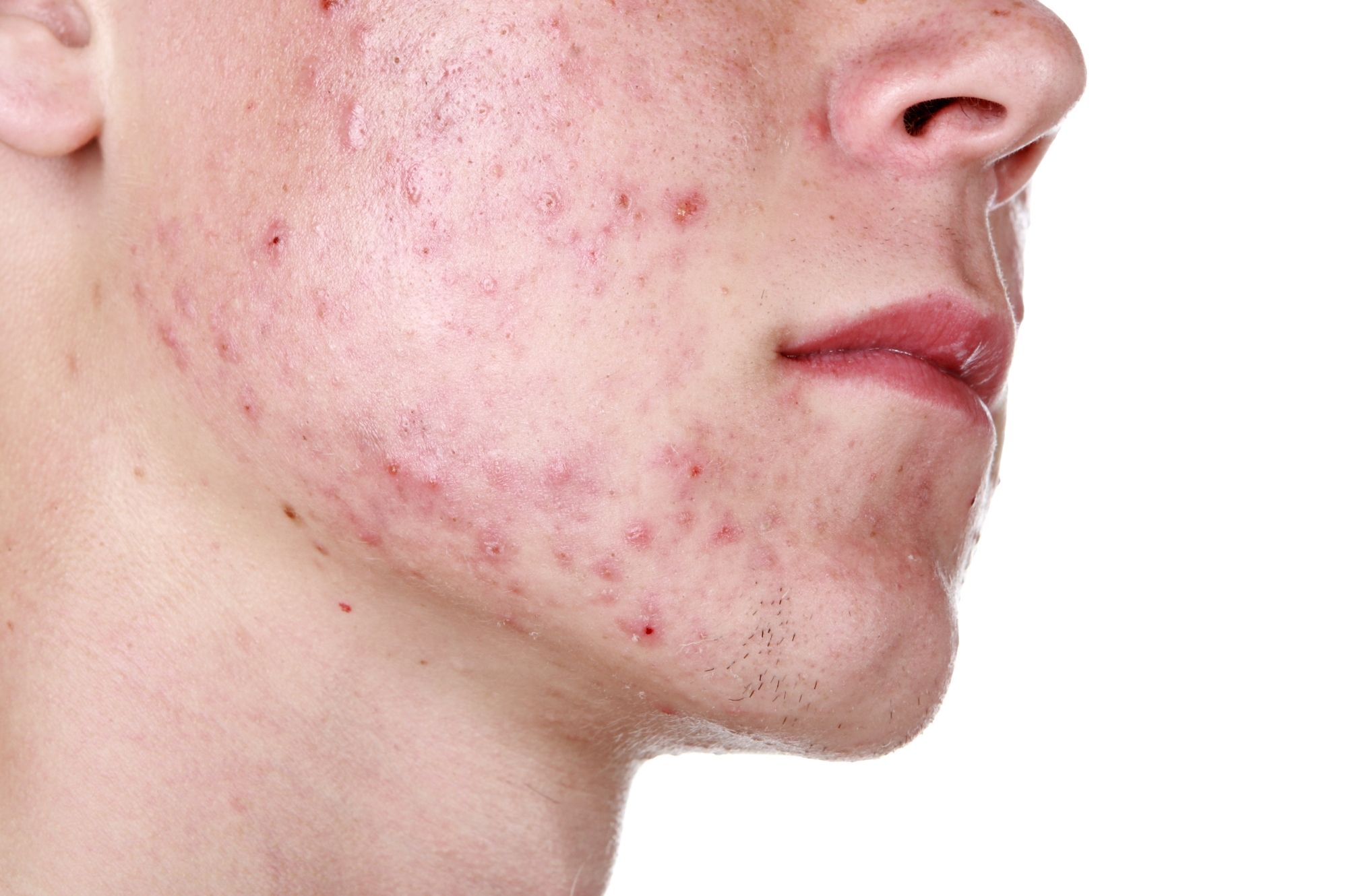 Estas son 10 cosas que debes saber acerca del acné