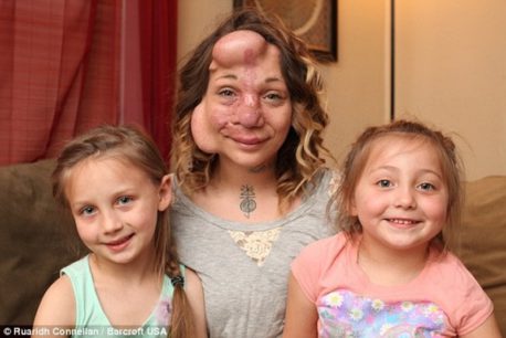 Fue obligada a vivir con protuberancias gigantes en su rostro. Hoy luce completamente diferente Fue obligada a vivir con protuberancias gigantes en su rostro. Hoy luce completamente diferente
