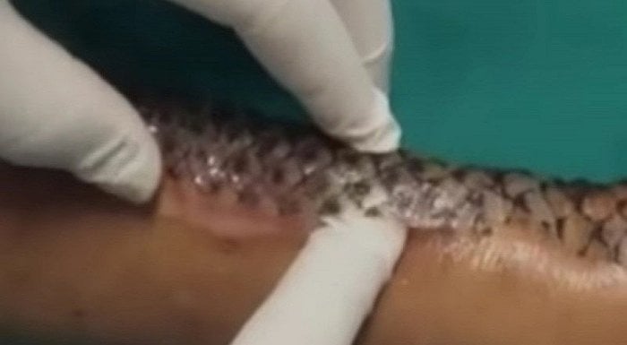 Mujer con graves quemaduras cubrió sus heridas con escamas de pescado y así quedó (Fotos + Video)