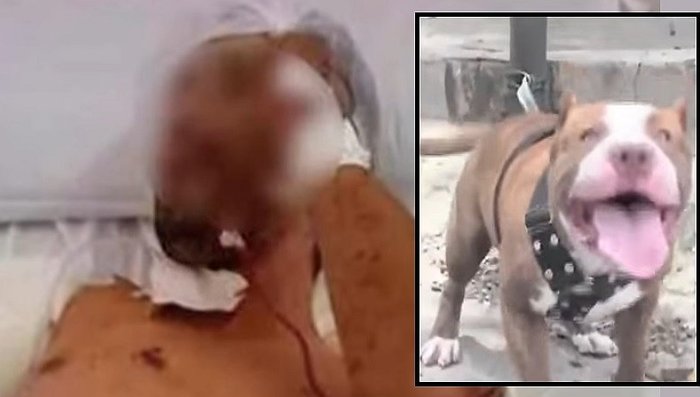 Le amputaron el brazo: Entró a robar a una casa pero fue atacado por un pitbull (Video)