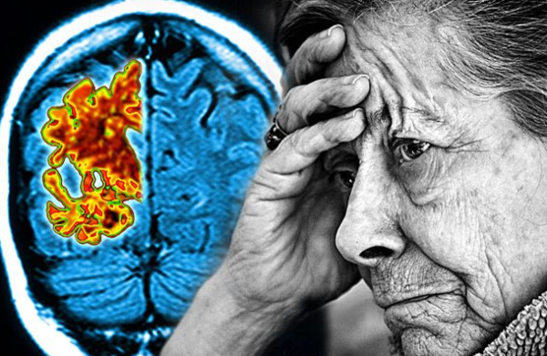 Científicos cubanos empiezan la prueba de un nuevo tratamiento para contrarrestar el Alzheimer