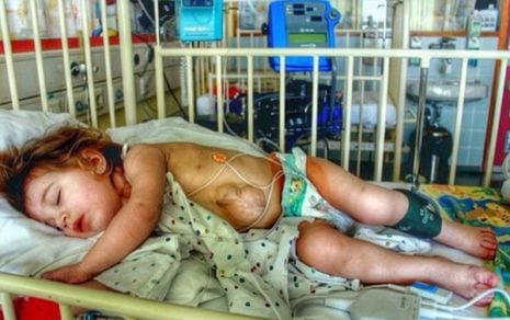 El impactante caso de la niña que nació con el corazón fuera del pecho y cuenta su historia en Instagram