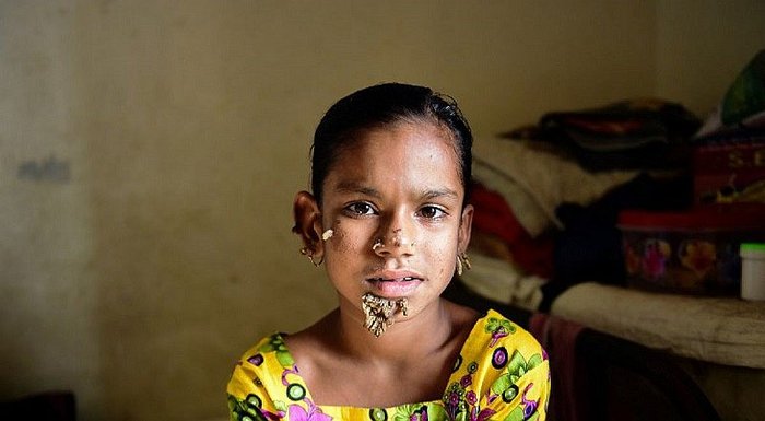Verrugas sin control: Diagnostican a niña con horrible y extraña enfermedad