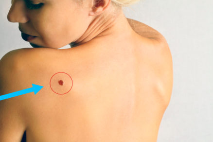 ¿Tienes estas manchitas en la piel? esto es lo que realmente significan