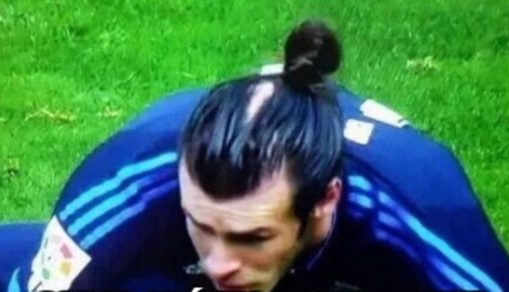 Gareth Bale preocupado por su inminente calvicie