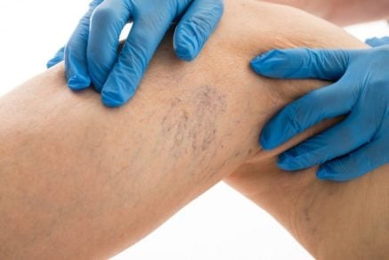 Porqué salen várices y «arañitas» en las piernas y cómo eliminarlas de forma natural