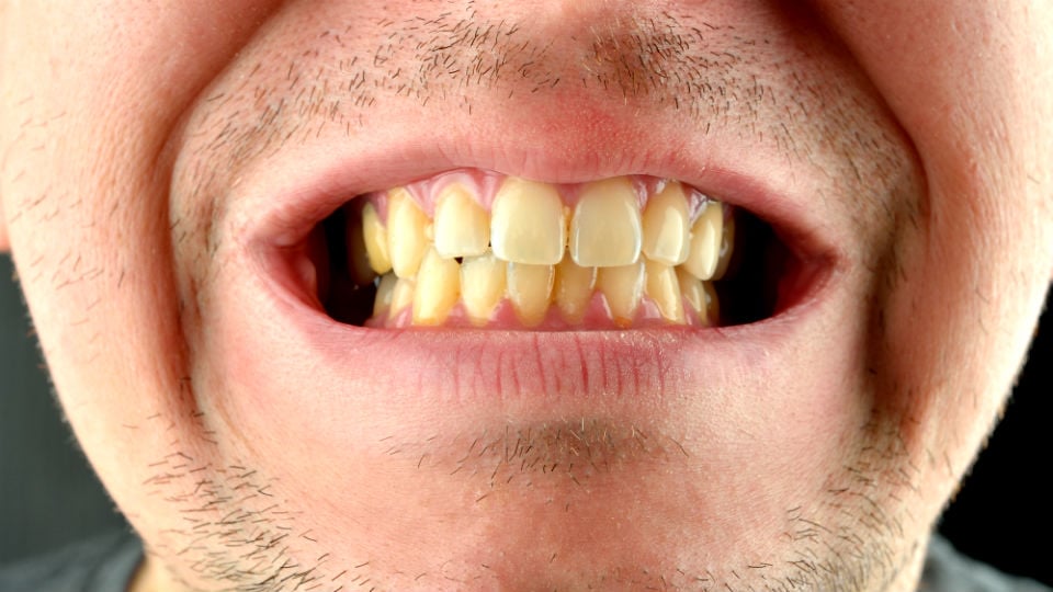 Este es un método eficaz y natural para ayudar a blanquear tus dientes