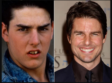 13 celebridades que se arreglaron la dentadura