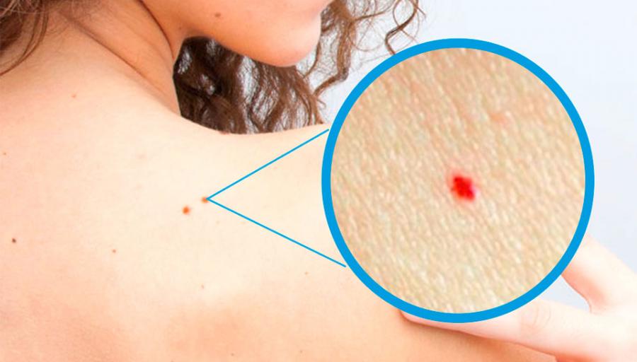 El Ciudadano Tienes Manchas Rojas En La Piel Descubre Lo Que Revelan De Tu Salud
