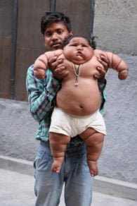 Fue llamada la bebé más gorda del mundo. Hoy, su vida corre peligro
