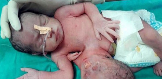 Insólito: Nace un bebé con gemelo parásito