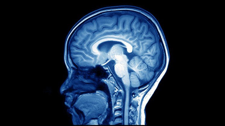 Un estudio revela ciertas diferencias en la actividad cerebral de hombres y mujeres