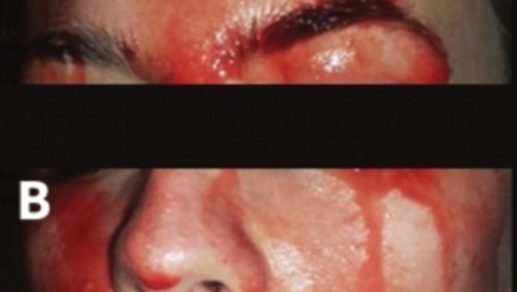 Desconcertante caso: mujer ‘suda sangre’ de cara y manos cuando se siente estresada o hace ejercicio