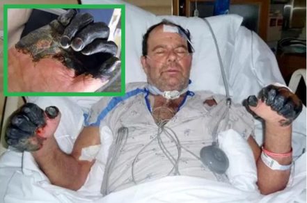 Su gato lo contagió con la PESTE BUBÓNICA, sus manos se hincharon como pomelos y perdió todos sus dedos tras sufrir necrosis