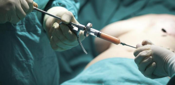 Mujer venezolana muere en medio de liposucción en clínica estética de Las Condes