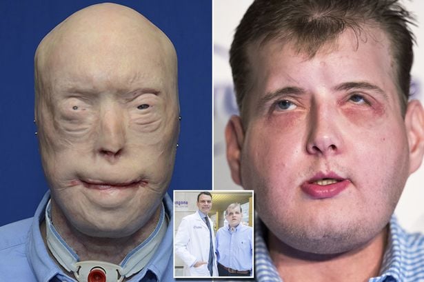 Cirujanos en Francia realizan por primera vez un segundo trasplante de cara a la misma persona