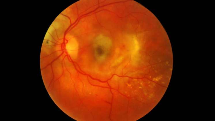 Médicos londinenses restauran la visión de dos pacientes con una forma común de ceguera