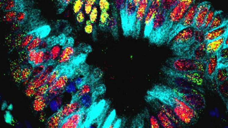 Investigadores hallan un mini sistema digestivo al interior de un cáncer de pulmón
