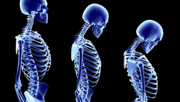 Los 7 indicadores más comunes de osteoporosis que no debes ignorar