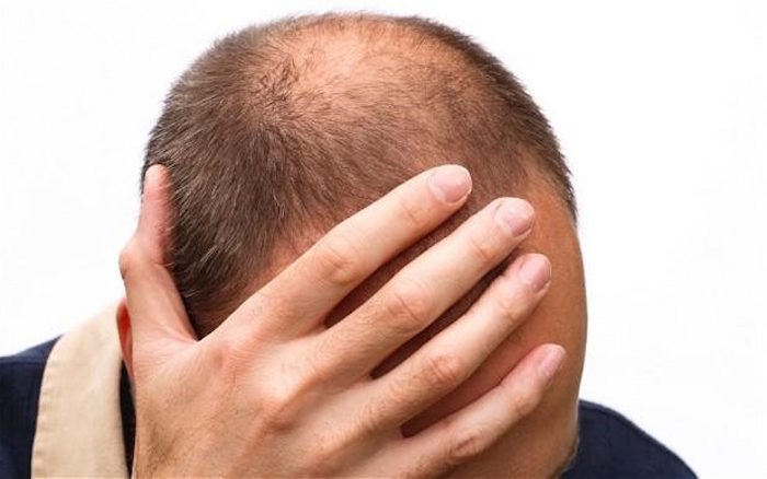 Investigadores descubren accidentalmente una potencial cura para la alopecia