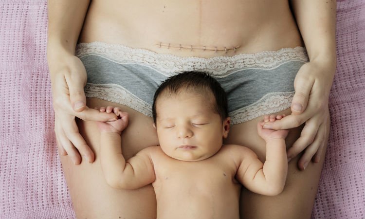 ¿Cesárea o parto vaginal? el dilema de una madre a punto de dar a luz