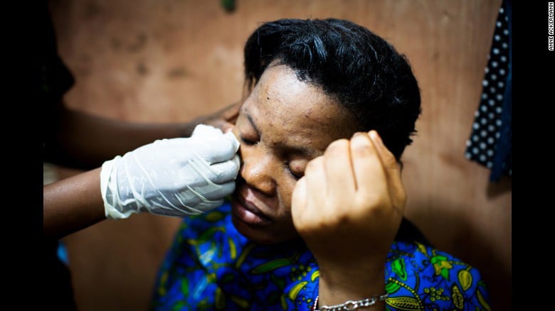 Moda nociva: Aclarar la piel se populariza en África