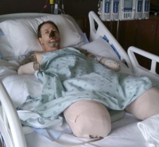 Hombre sufre amputaciones de extremidades tras infección por lamida de perro