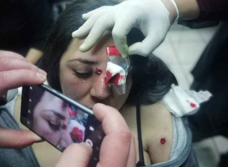 Estudiante de la U. Iberoamericana recibió seis perdigones disparados por Carabineros