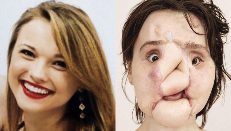 Katie, la mujer más joven en recibir un trasplante de cara