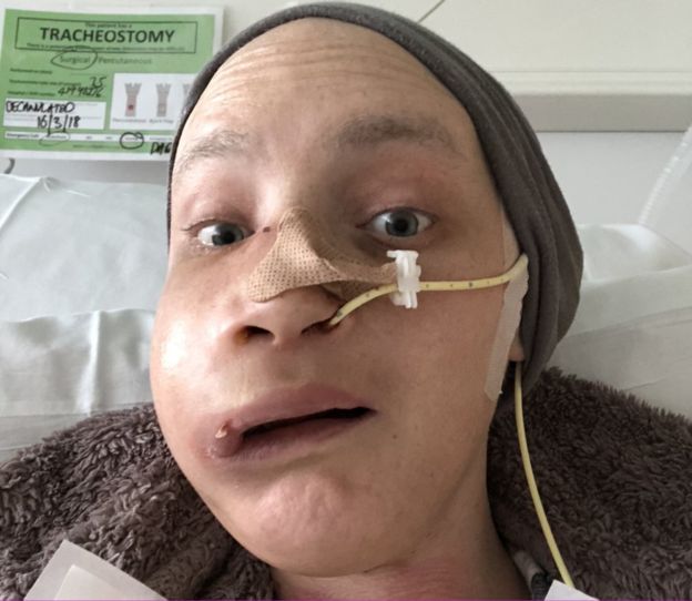 (Fotos) «Psicológicamente, no estaba en absoluto preparada», dijo joven que padeció cáncer de hueso y tuvo que someterse a una reconstrucción facial