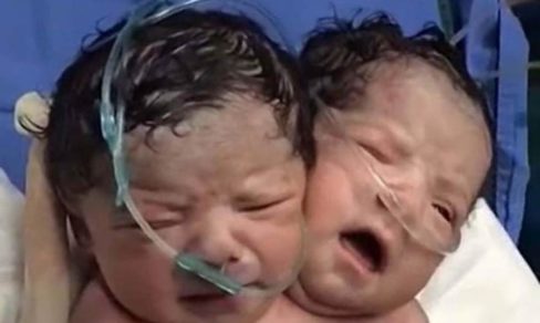 Siameses unidos por el cráneo podrían ser separados y verse cara a cara