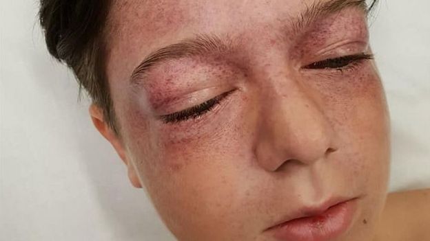 (Video+Fotos) Peligroso reto de YouTube causa en niño de 11 años heridas similares a las de pilotos de combate