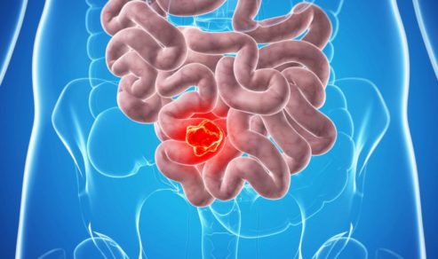 Conoce los factores de riesgo: 600 mil nuevos casos de cáncer intestinal se registran en el mundo