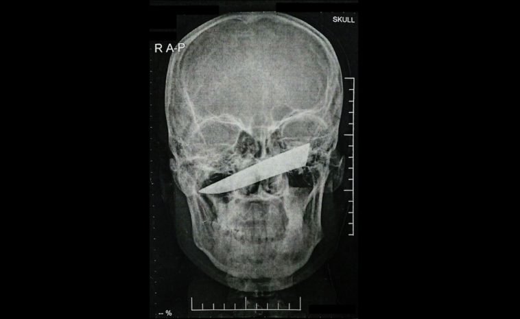 (Fotos) Un hombre pasó 4 días con un cuchillo enterrado en la cara
