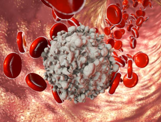 Nuevo medicamento podría eliminar la leucemia mieloide aguda