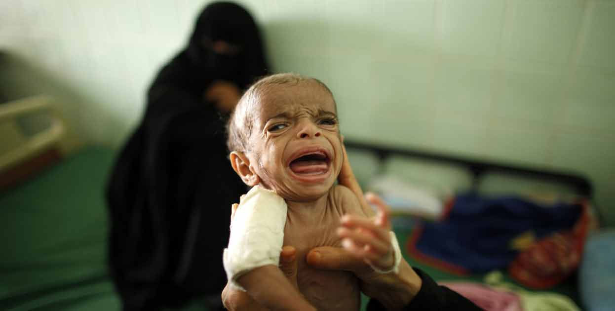 Agresión saudí en Yemen es culpable de la muerte de 85.000 niños por desnutrición