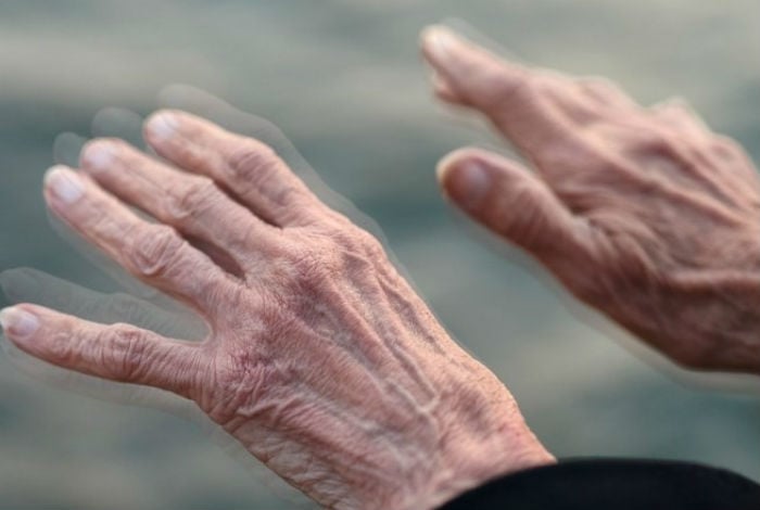 Científicos suecos encontraron relación entre el apéndice y el Parkinson