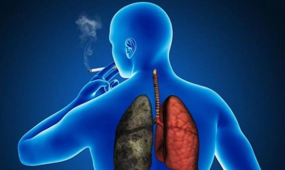 El tabaquismo primera causa del cáncer de pulmón