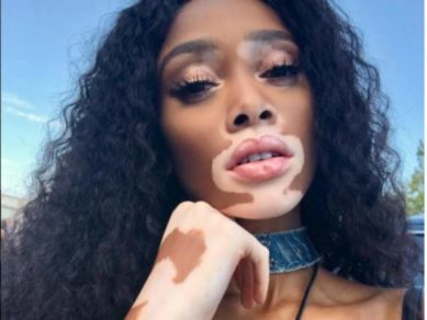 (+Fotos y Video) Conozca la primera modelo con vitíligo en posar en traje de baño para revista deportiva