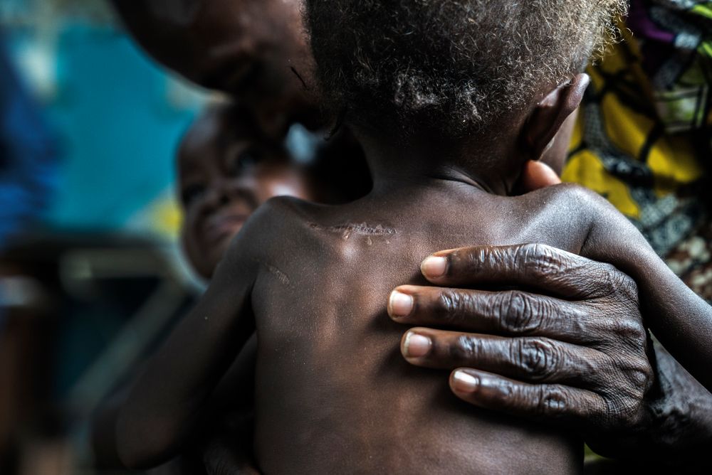 Desnutrición aguda causa estragos en la población infantil del Congo