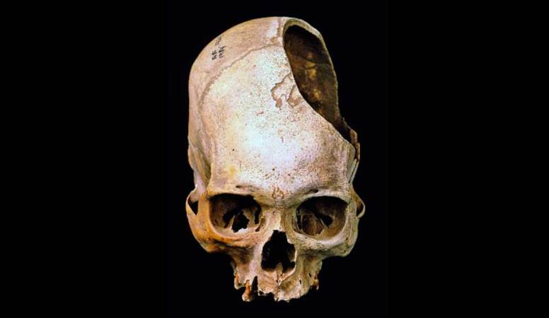Cirugías de cráneo prehispánicas: Los incas superaban con creces a los cirujanos estadounidenses de la guerra civil