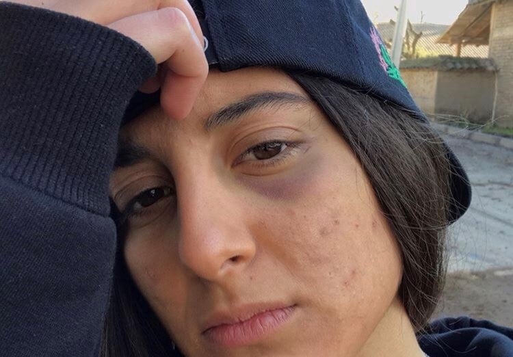 «Me rasguñaron con piedras el brazo»: Joven denuncia agresión homófoba en Las Condes