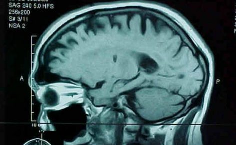 Crean una nueva terapia CART que logra eliminar el cáncer cerebral