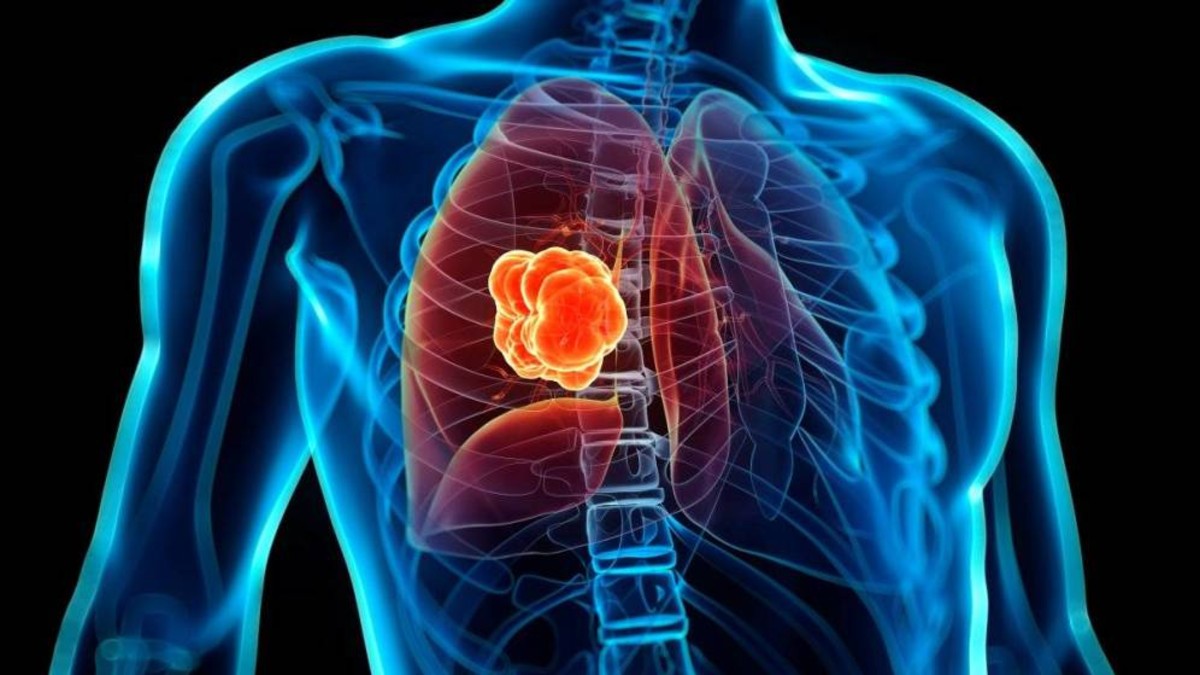 La forma farmacéutica de la vitamina B1 puede inhibir células del cáncer pulmonar